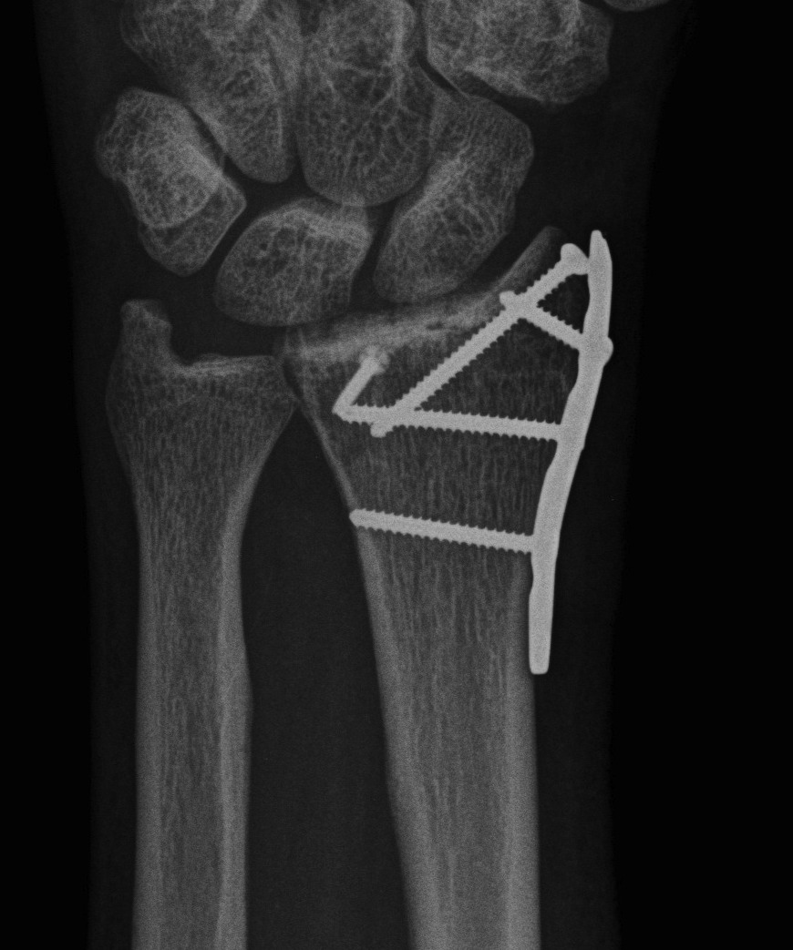 Dorsal Radiocarpal Dislocation ORIF 2